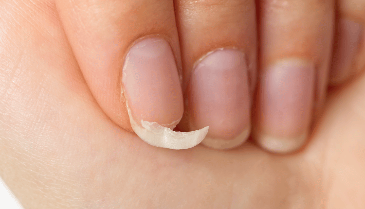 Unhas frágeis e quebradiças.